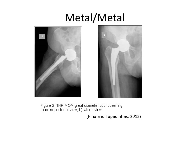 Metal/Metal a. b. Figure 2. THR MOM great diameter cup loosening a)anteroposterior view; b)