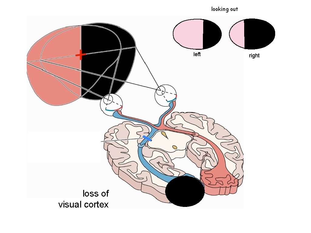 looking out left loss of visual cortex right 