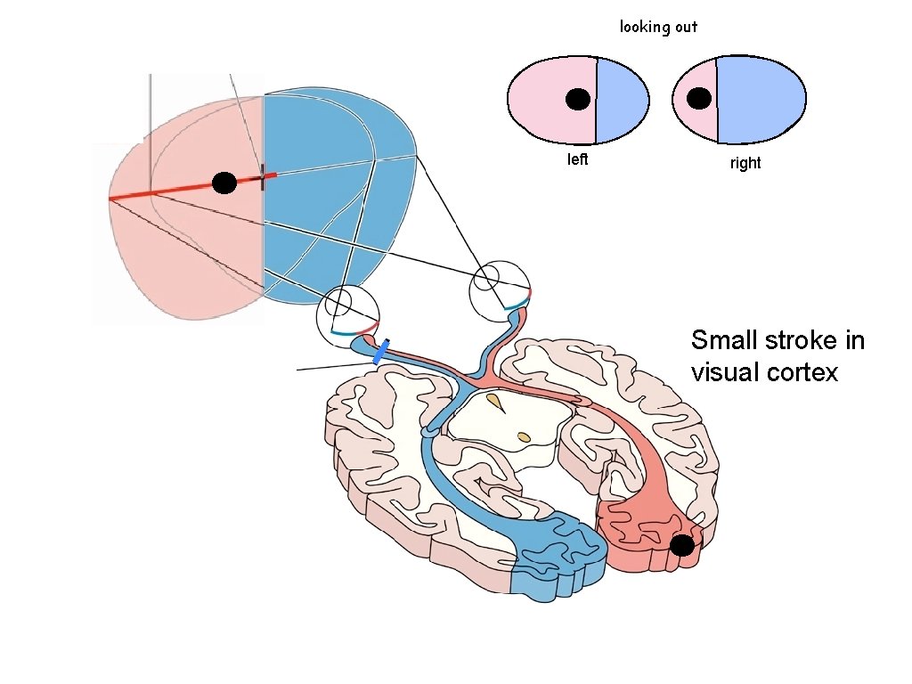 looking out left right Small stroke in visual cortex 