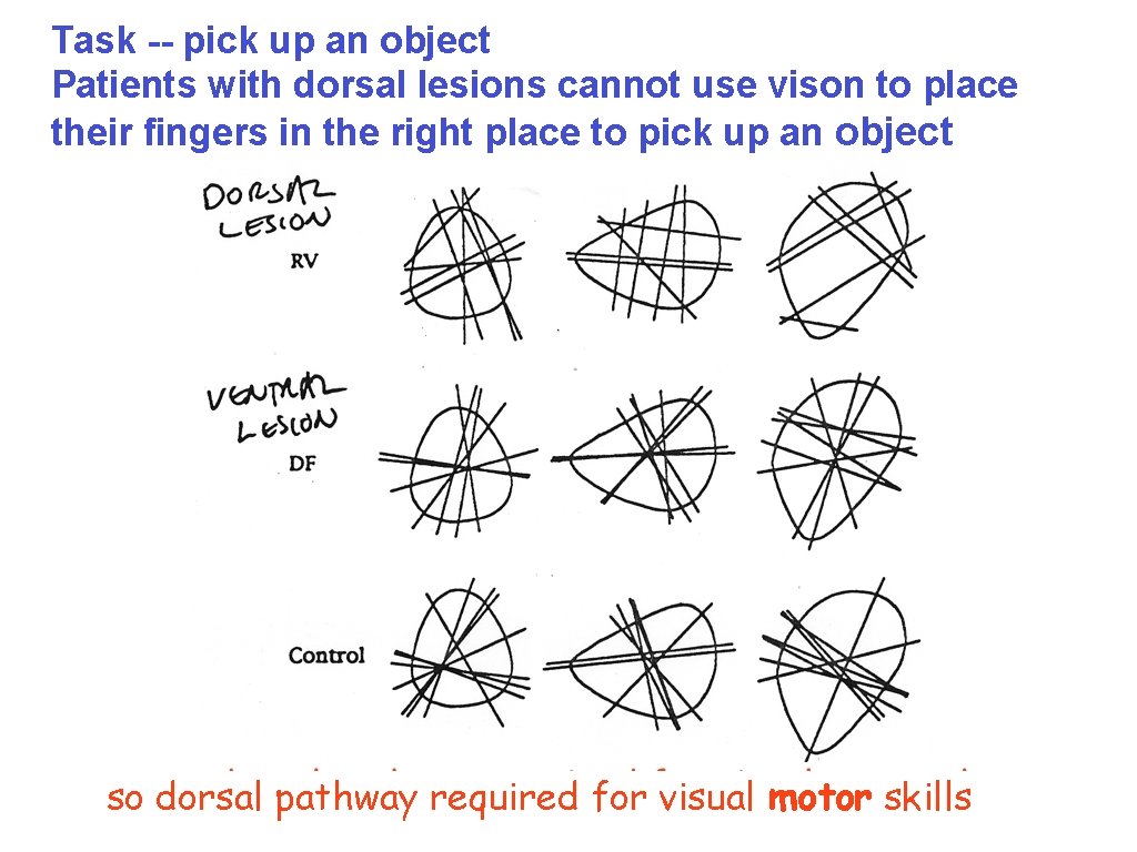 Task -- pick up an object Patients with dorsal lesions cannot use vison to