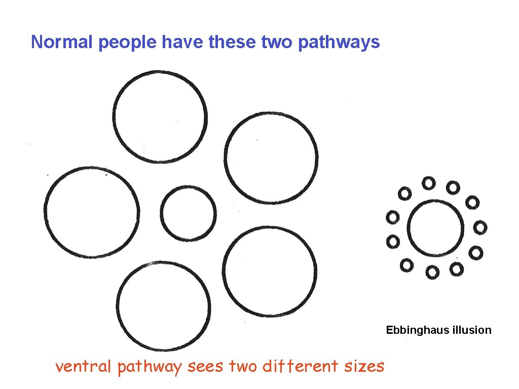Normal people have these two pathways Ebbinghaus illusion ventral pathway sees two different sizes