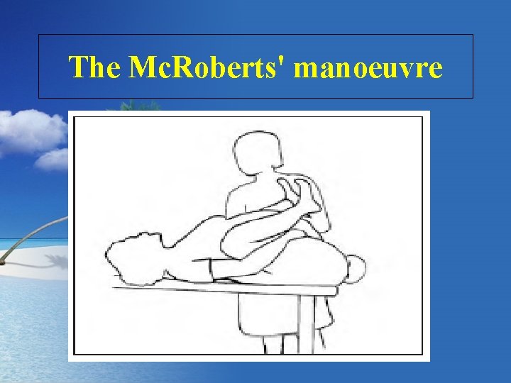 The Mc. Roberts' manoeuvre 