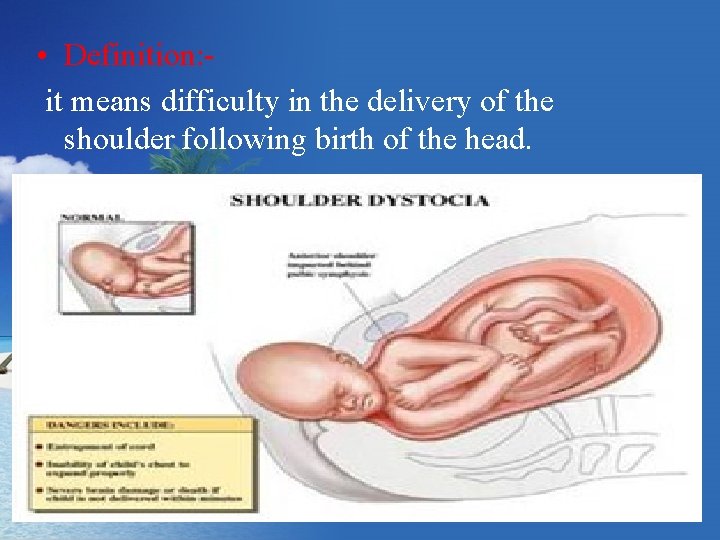  • Definition: it means difficulty in the delivery of the shoulder following birth