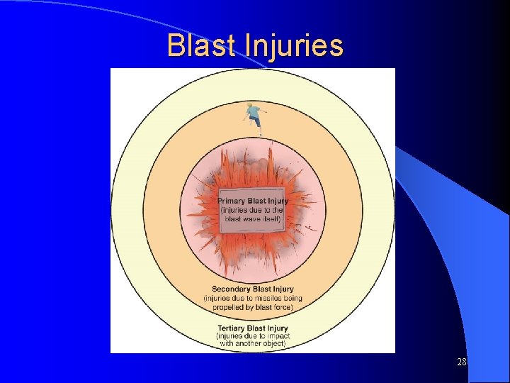 Blast Injuries 28 Blast Injuries 28