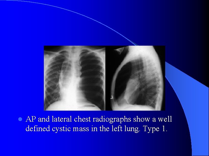 l AP and lateral chest radiographs show a well defined cystic mass in the