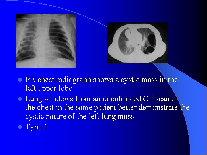 PA chest radiograph shows a cystic mass in the left upper lobe l Lung