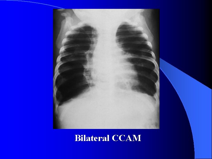 Bilateral CCAM Bilateral CCAM
