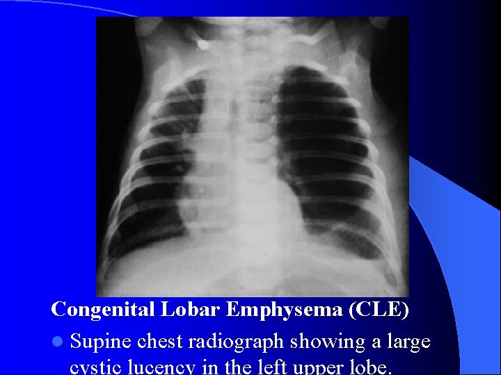Congenital Lobar Emphysema (CLE) l Supine chest radiograph showing a large cystic lucency in