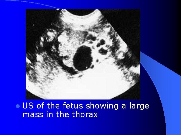 l US of the fetus showing a large mass in the thorax 