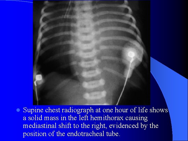 l Supine chest radiograph at one hour of life shows a solid mass in