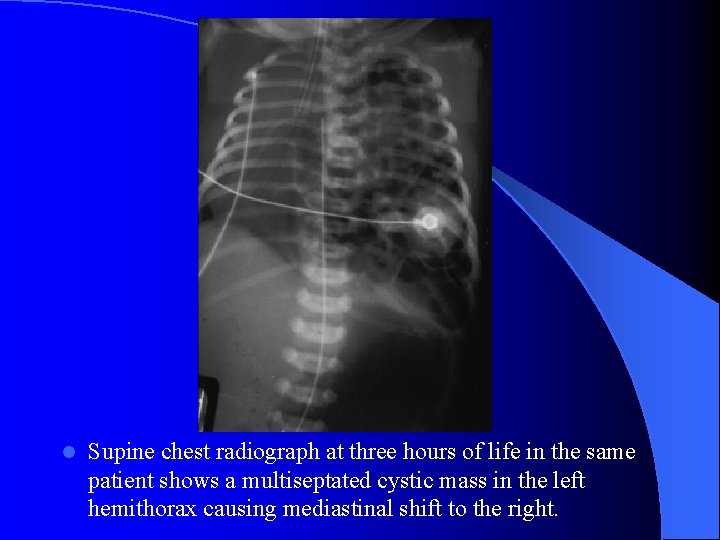l Supine chest radiograph at three hours of life in the same patient shows