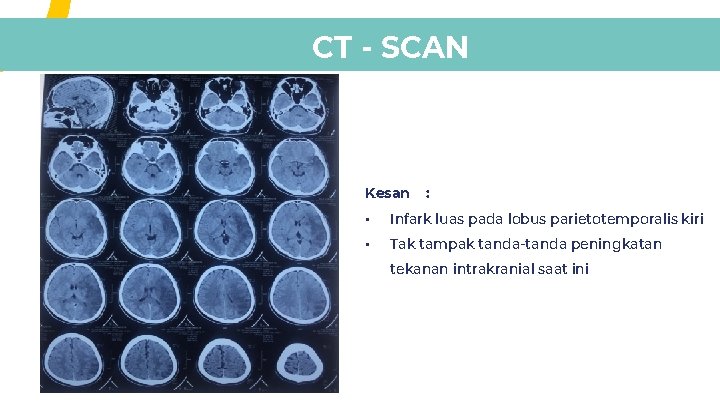 CT - SCAN Kesan : • Infark luas pada lobus parietotemporalis kiri • Tak CT - SCAN Kesan : • Infark luas pada lobus parietotemporalis kiri • Tak
