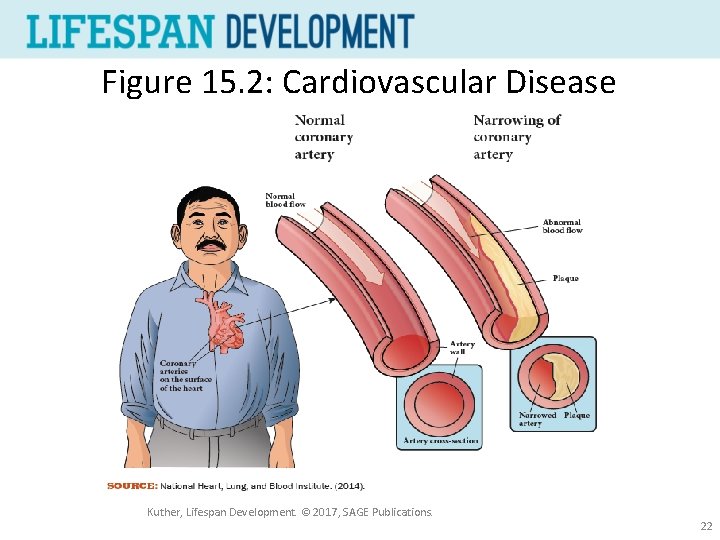 Figure 15. 2: Cardiovascular Disease Kuther, Lifespan Development. © 2017, SAGE Publications. 22 
