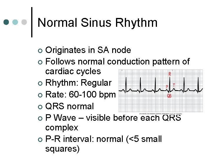 Normal Sinus Rhythm Originates in SA node ¢ Follows normal conduction pattern of cardiac