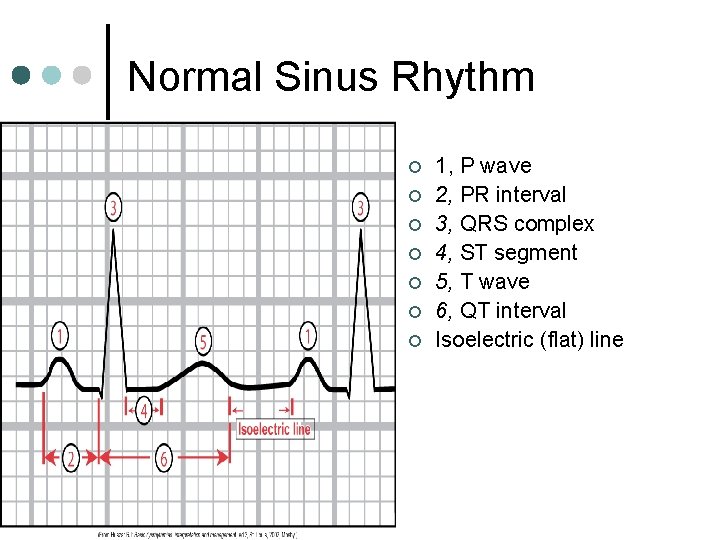 Normal Sinus Rhythm ¢ ¢ ¢ ¢ 1, P wave 2, PR interval 3,