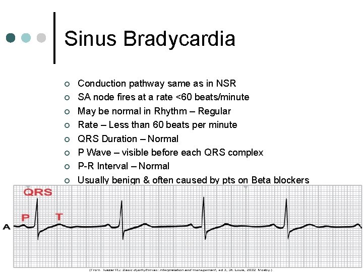 Sinus Bradycardia ¢ ¢ ¢ ¢ Conduction pathway same as in NSR SA node