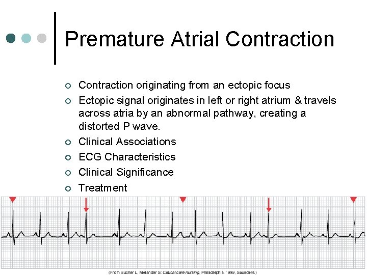 Premature Atrial Contraction ¢ ¢ ¢ Contraction originating from an ectopic focus Ectopic signal