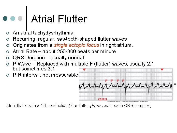 Atrial Flutter ¢ ¢ ¢ ¢ An atrial tachydysrhythmia Recurring, regular, sawtooth-shaped flutter waves