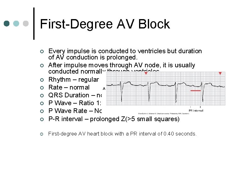 First-Degree AV Block ¢ Every impulse is conducted to ventricles but duration of AV