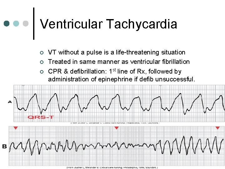 Ventricular Tachycardia ¢ ¢ ¢ VT without a pulse is a life-threatening situation Treated