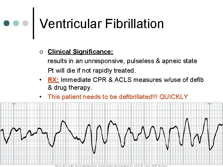 Ventricular Fibrillation Clinical Significance: results in an unresponsive, pulseless & apneic state Pt will