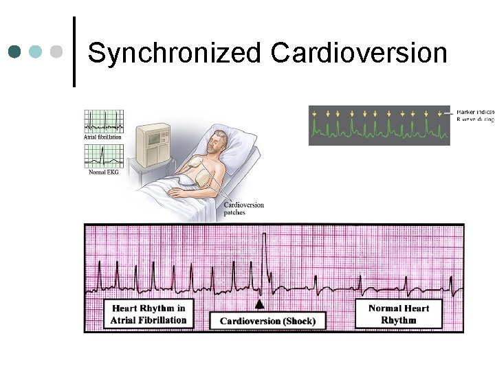 Synchronized Cardioversion 