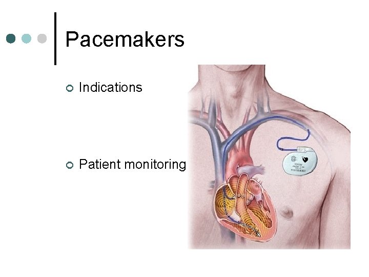 Pacemakers ¢ Indications ¢ Patient monitoring 