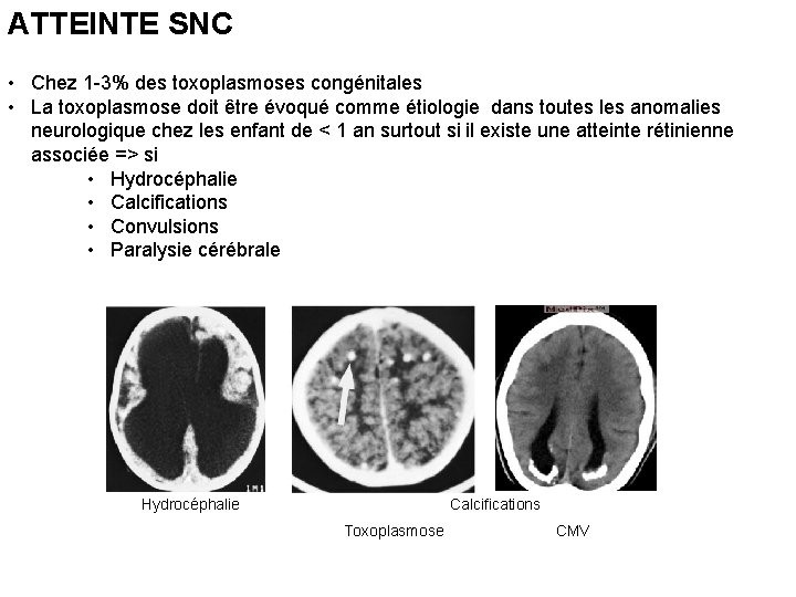 ATTEINTE SNC • Chez 1 -3% des toxoplasmoses congénitales • La toxoplasmose doit être