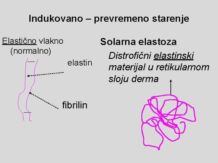 Indukovano – prevremeno starenje Elastično vlakno (normalno) Solarna elastoza Distrofični elastinski elastin materijal u