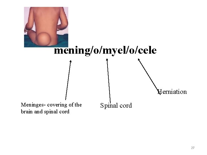 mening/o/myel/o/cele Herniation Meninges- covering of the brain and spinal cord Spinal cord 27 