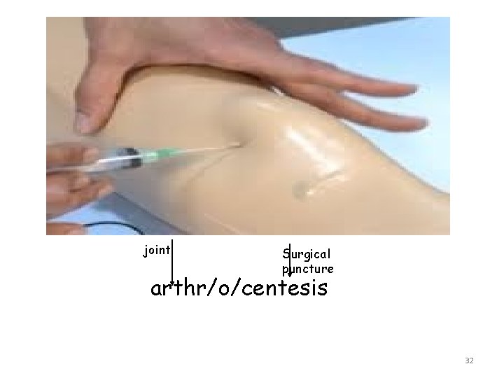 joint Surgical puncture arthr/o/centesis 32 