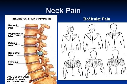 Neck Pain Radicular Pain 