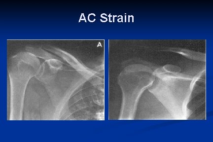 AC Strain 