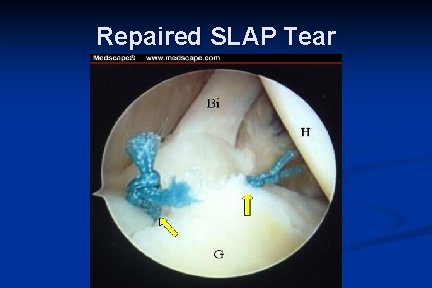 Repaired SLAP Tear 