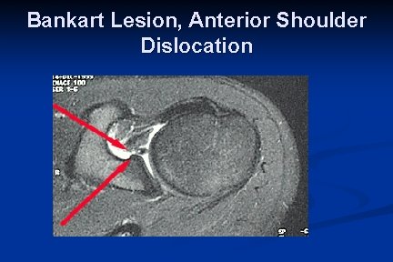 Bankart Lesion, Anterior Shoulder Dislocation 