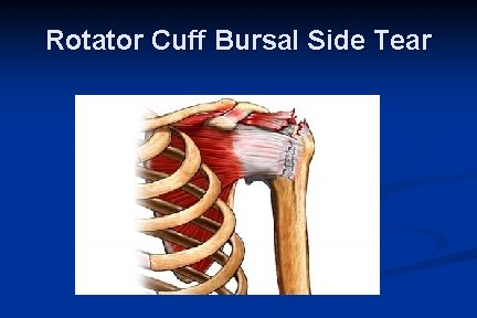 Rotator Cuff Bursal Side Tear 