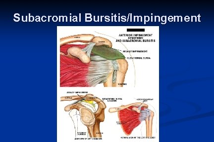 Subacromial Bursitis/Impingement 