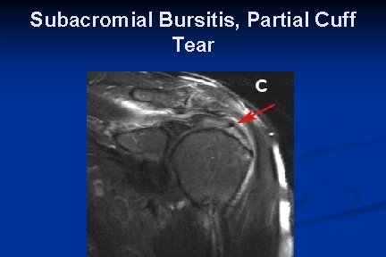 Subacromial Bursitis, Partial Cuff Tear 