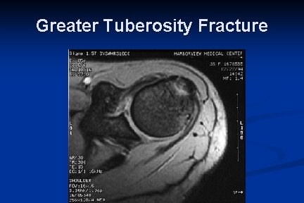 Greater Tuberosity Fracture 