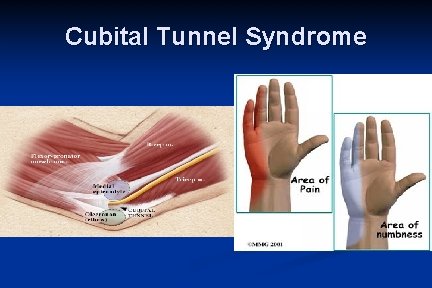 Cubital Tunnel Syndrome 