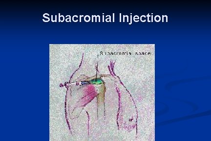 Subacromial Injection 