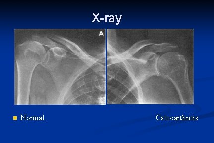 X-ray n Normal Osteoarthritis 