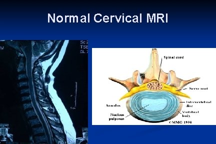 Normal Cervical MRI 