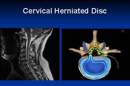 Cervical Herniated Disc 