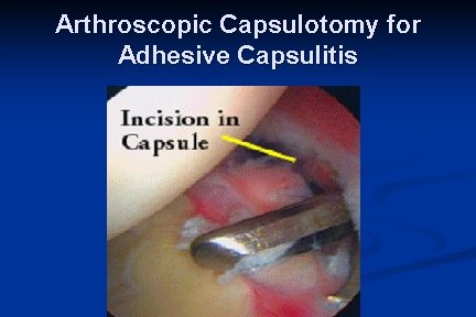 Arthroscopic Capsulotomy for Adhesive Capsulitis 