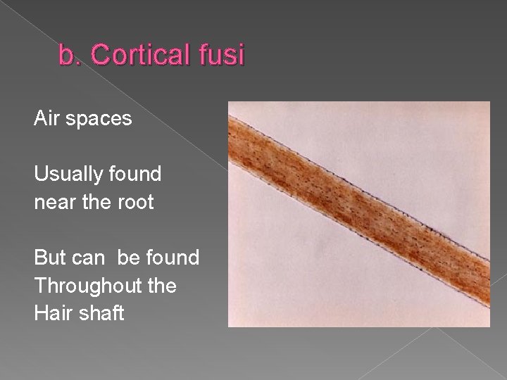 b. Cortical fusi Air spaces Usually found near the root But can be found