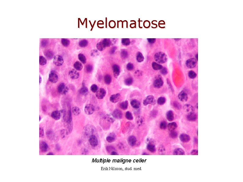 Myelomatose Multiple maligne celler Erik Nilsson, stud. med. 