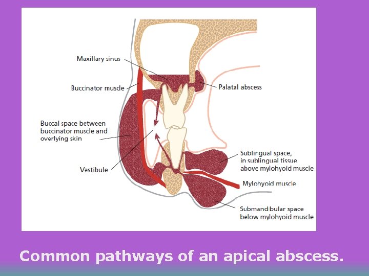 Common pathways of an apical abscess. 