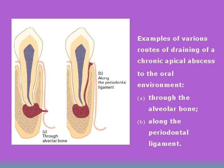 Examples of various routes of draining of a chronic apical abscess to the oral