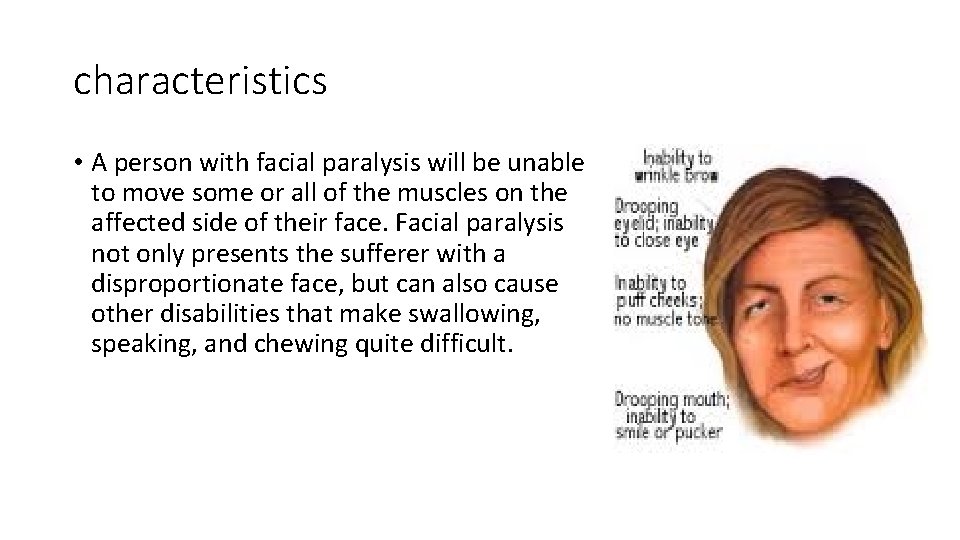 characteristics • A person with facial paralysis will be unable to move some or